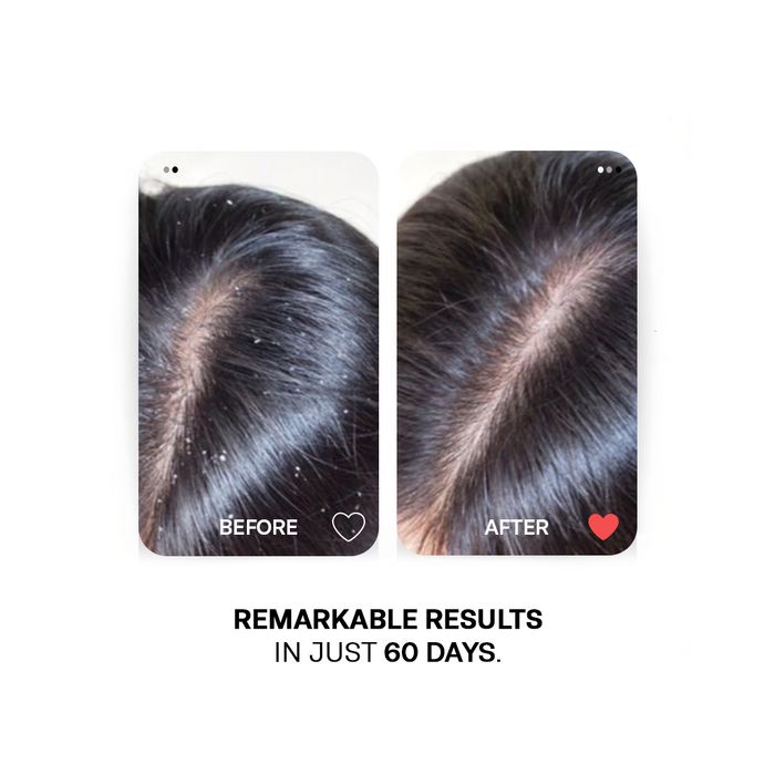 Anti-Dandruff Scalp Care Range